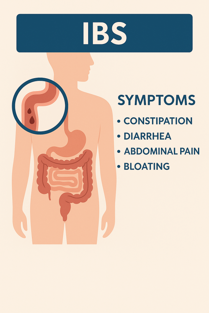 Understanding IBS: Symptoms, Causes, and Treatment Options 1 Infographic showing symptoms of IBS (Irritable Bowel Syndrome) including constipation, diarrhea, abdominal pain, and bloating, with a human digestive system illustration highlighting the intestines