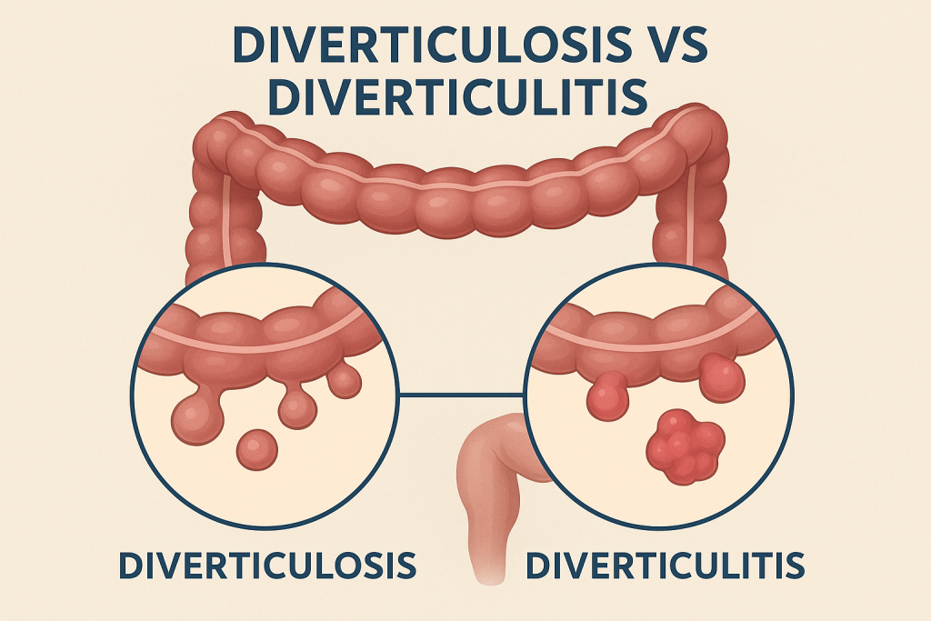 Diverticulosis vs Diverticulitis 1 Medical illustration comparing diverticulosis and diverticulitis in the colon, showing healthy pouches on the left and inflamed, infected pouches on the right