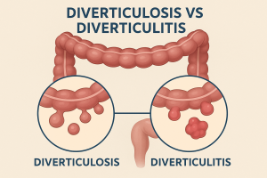 Comprehensive Gastroenterology Services in Rockdale County: Your Health Matters at Colon and Digestive Health Specialists LLC 2 "Medical illustration comparing diverticulosis and diverticulitis in the colon, showing healthy pouches on the left and inflamed, infected pouches on the right"