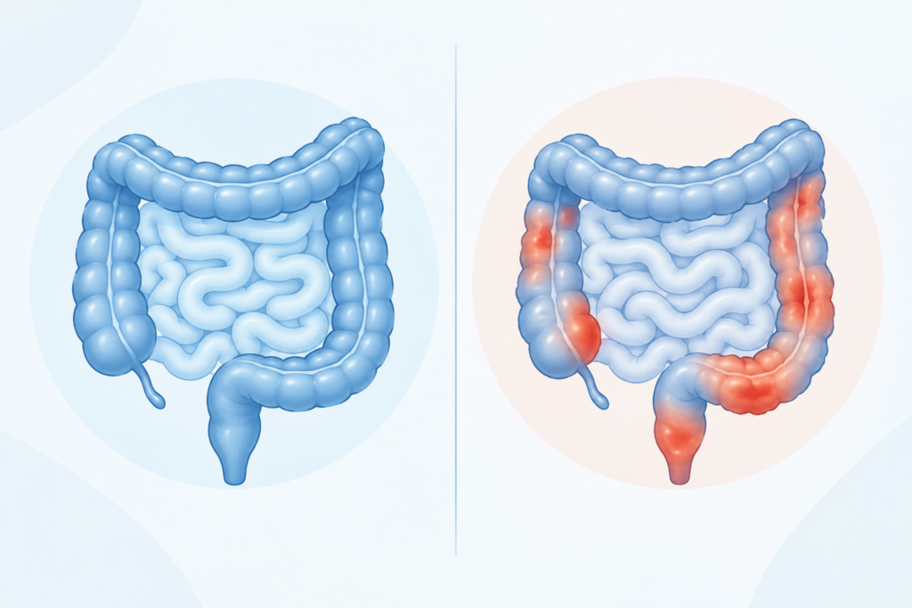 "Illustration comparing a healthy intestine in IBS with an inflamed intestine in IBD"